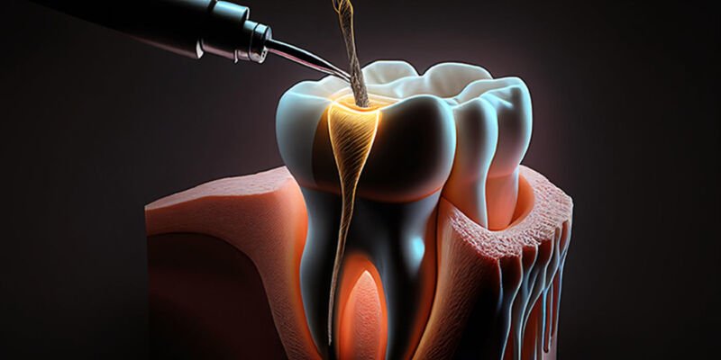 Endodoncja na czym polega nowoczesne leczenie kanałowe pod