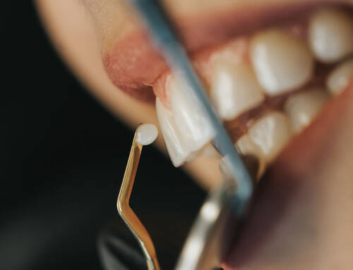 Bonding – sposób na szybką i precyzyjną odbudowę zniszczonych zębów