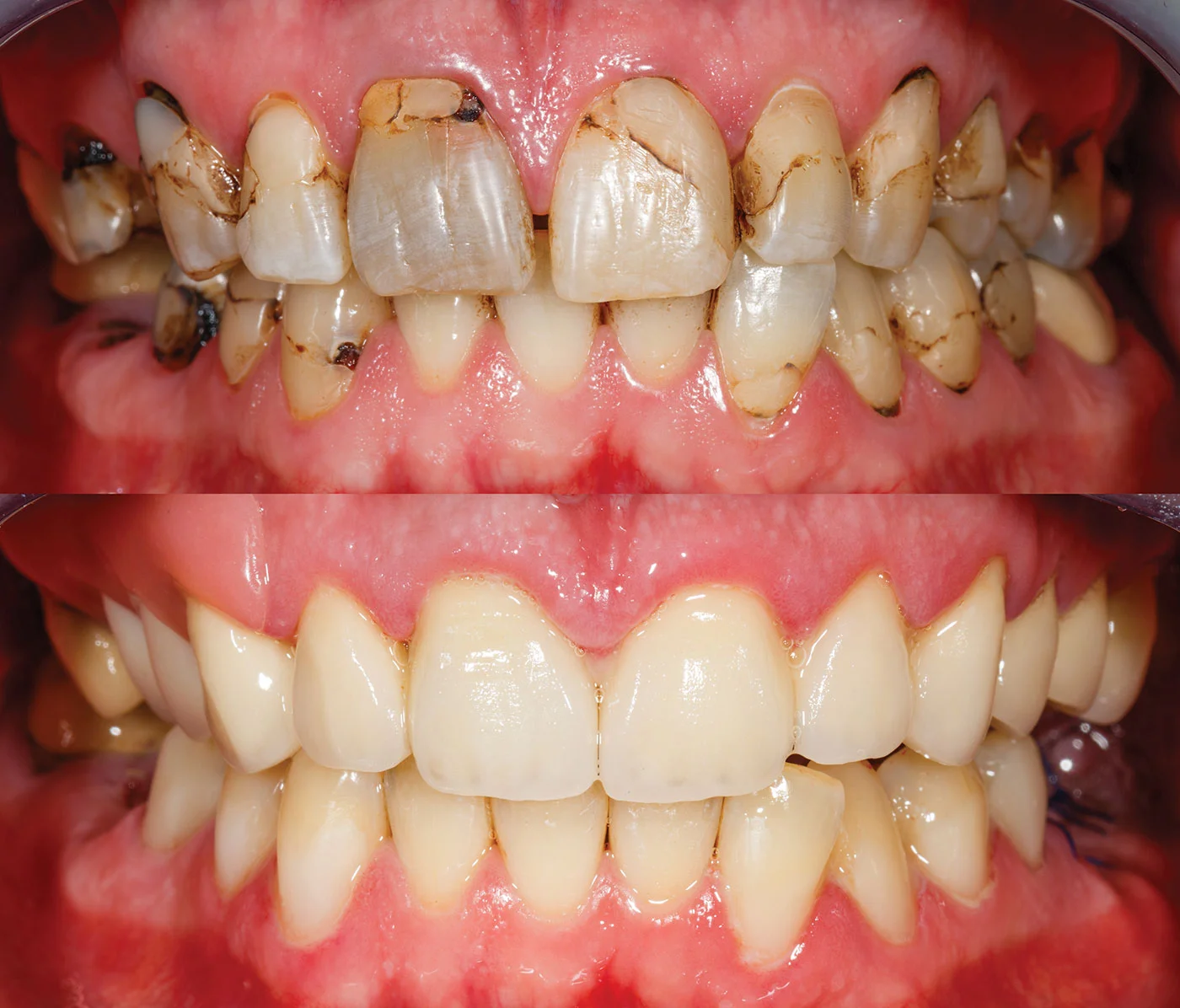 Odbudowa zniszczonych zębów metodą bondingu (przed / po).