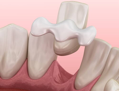 Most adhezyjny – sposób na odbudowę zęba