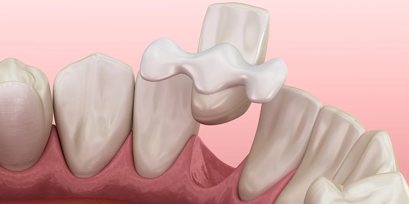 Most adhezyjny - sposób na odbudowę zęba