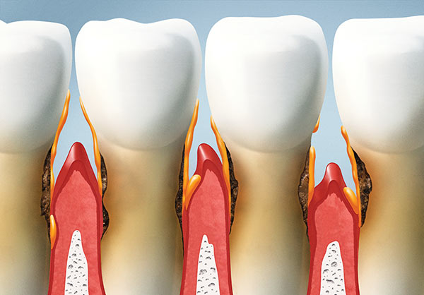 Czym jest periodontologia?